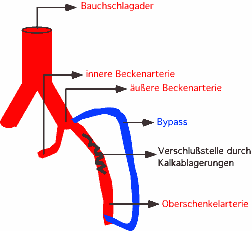 bypass